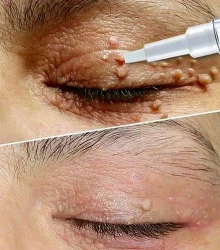 Eliminar verrugas y lunares en rostro manos cuello pecho espalda ingle pies 255703235