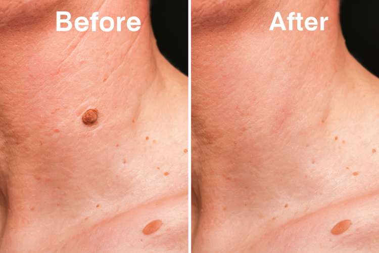 Eliminar verrugas y lunares en rostro manos cuello pecho espalda ingle pies 255703235