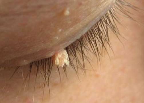 Eliminar verrugas y lunares en rostro manos cuello pecho espalda ingle pies 255703235