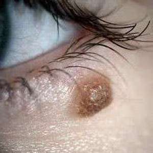 Eliminar verrugas y lunares en rostro manos cuello pecho espalda ingle pies 255703235